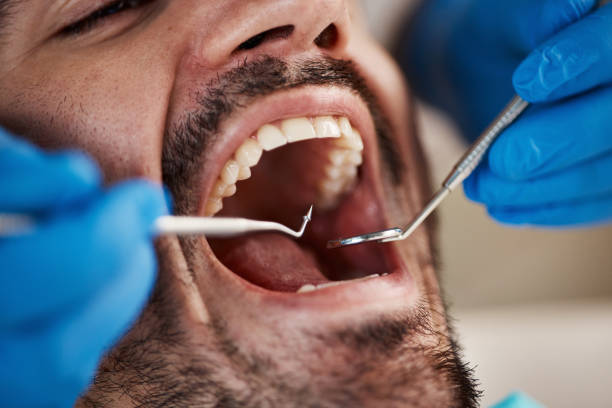 Dental Inlays and Onlays in Southside, AL